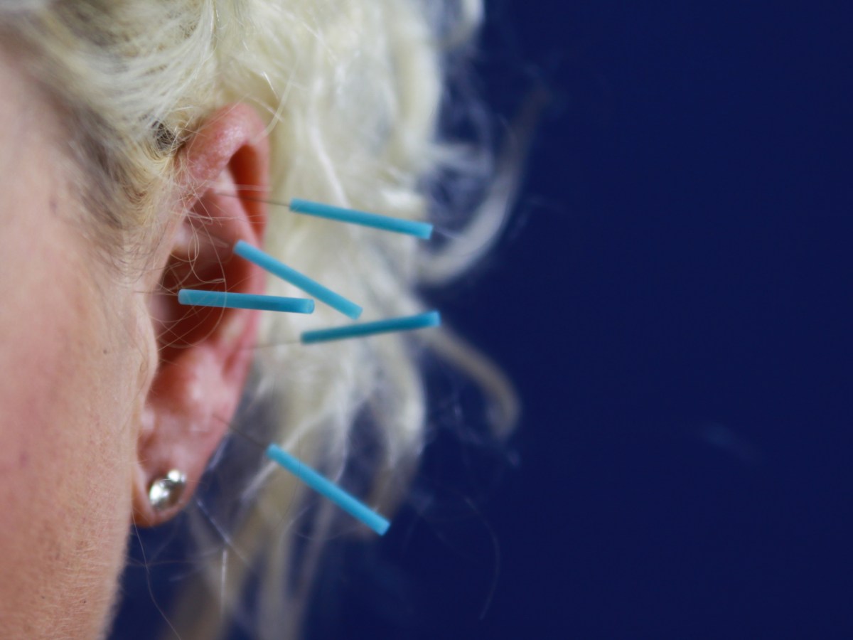 Auricular medicine offers needle-free acupuncture on the&nbsp;go
